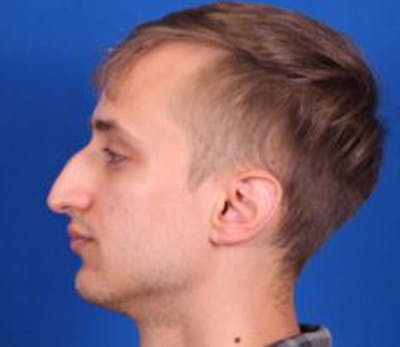 Rhinoplasty Before & After Gallery - Patient 102925400 - Image 1