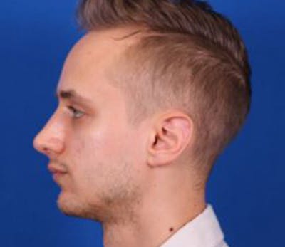 Rhinoplasty Before & After Gallery - Patient 102925400 - Image 2