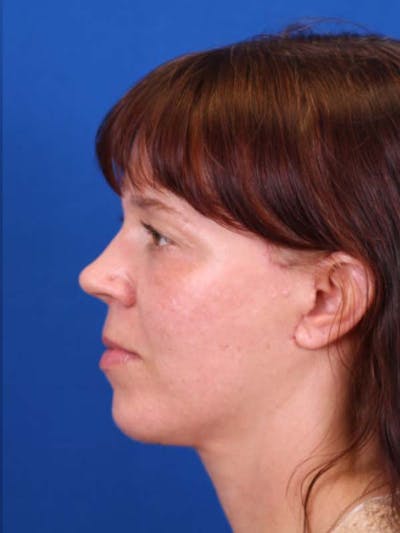 Blepharoplasty Before & After Gallery - Patient 121544172 - Image 6