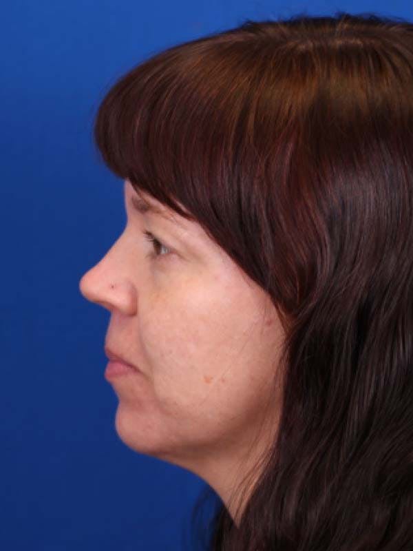 Blepharoplasty Before & After Gallery - Patient 121544172 - Image 5