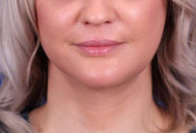 Facelift/Neck Lift Before & After Gallery - Patient 102925516 - Image 2