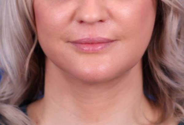 Facelift/Neck Lift Before & After Gallery - Patient 102925516 - Image 2
