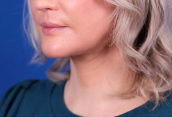 Facelift/Neck Lift Before & After Gallery - Patient 102925516 - Image 4