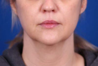 Facelift/Neck Lift Before & After Gallery - Patient 102925516 - Image 1
