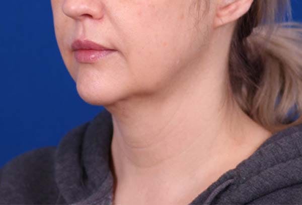 Facelift/Neck Lift Before & After Gallery - Patient 102925516 - Image 3