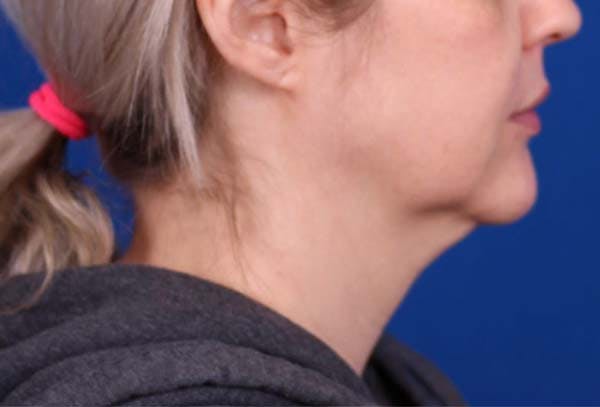 Facelift/Neck Lift Before & After Gallery - Patient 102925516 - Image 5