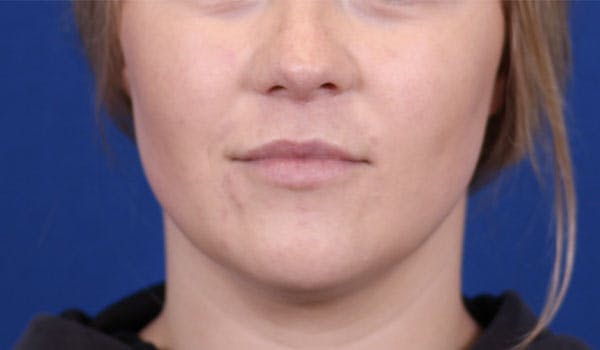 Lip Augmentation Before & After Gallery - Patient 148099124 - Image 1