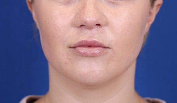 Lip Augmentation Before & After Gallery - Patient 148099124 - Image 2