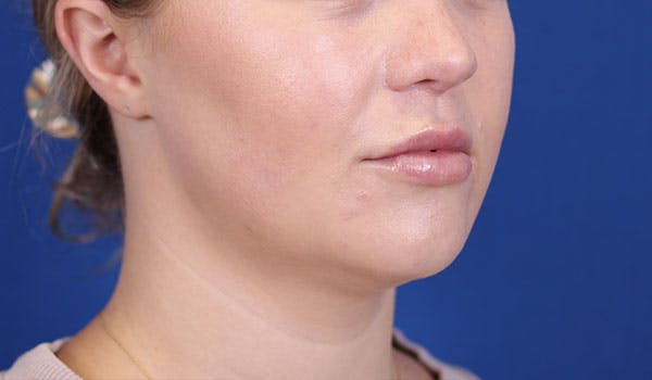 Lip Filler Before & After Gallery - Patient 122270484 - Image 4
