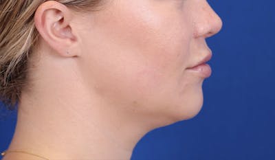 Lip Filler Before & After Gallery - Patient 122270484 - Image 6