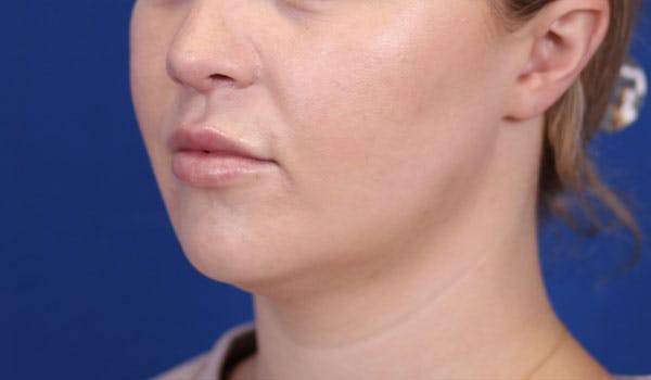 Lip Filler Before & After Gallery - Patient 122270484 - Image 8