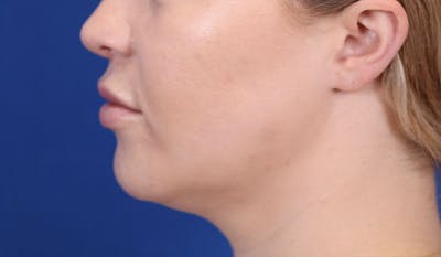 Lip Augmentation Before & After Gallery - Patient 148099124 - Image 10