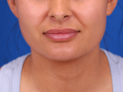 Lip Filler Before & After Gallery - Patient 141113771 - Image 2