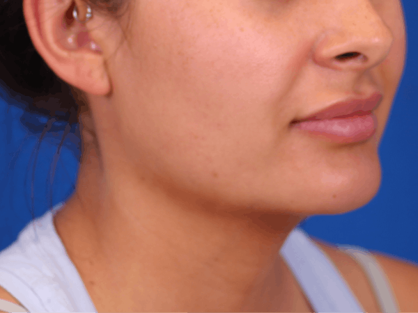 Lip Augmentation Before & After Gallery - Patient 148099079 - Image 4