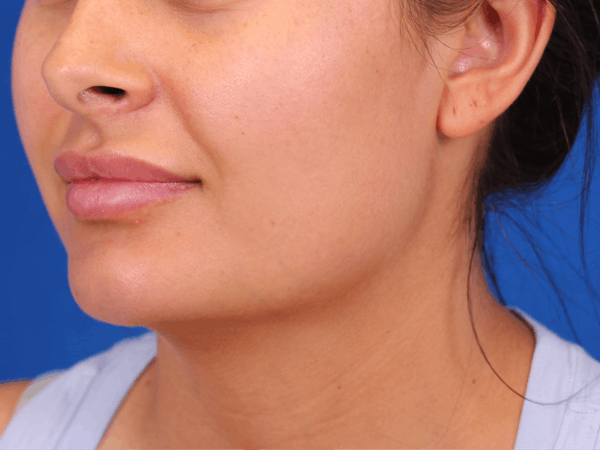 Lip Filler Before & After Gallery - Patient 141113771 - Image 8