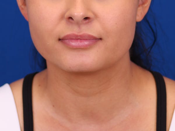 Lip Filler Before & After Gallery - Patient 141113771 - Image 1