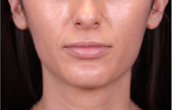 Lip Augmentation Before & After Gallery - Patient 148099161 - Image 1