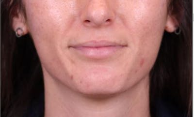 Lip Augmentation Before & After Gallery - Patient 148099161 - Image 2