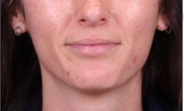 Lip Augmentation Before & After Gallery - Patient 148099161 - Image 2
