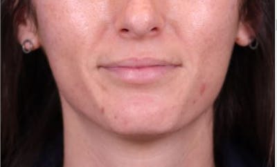 Lip Filler Before & After Gallery - Patient 142961400 - Image 2