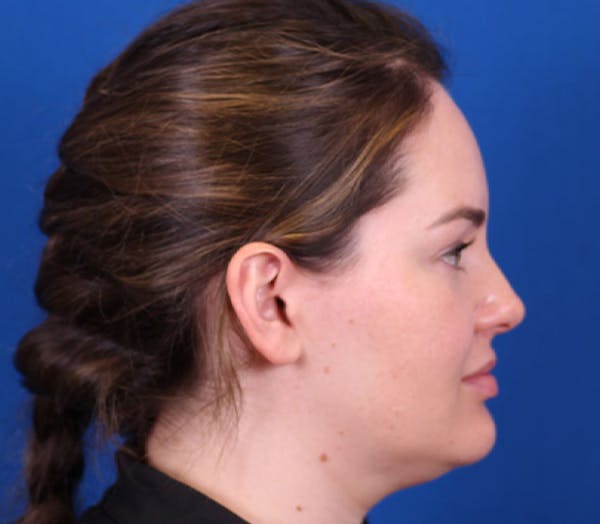 Neck deFINE Before & After Gallery - Patient 143289099 - Image 3