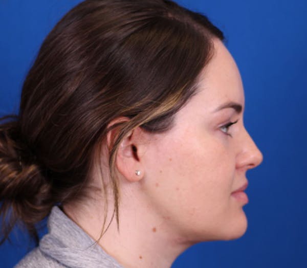 Neck Contouring Before & After Gallery - Patient 143289099 - Image 4