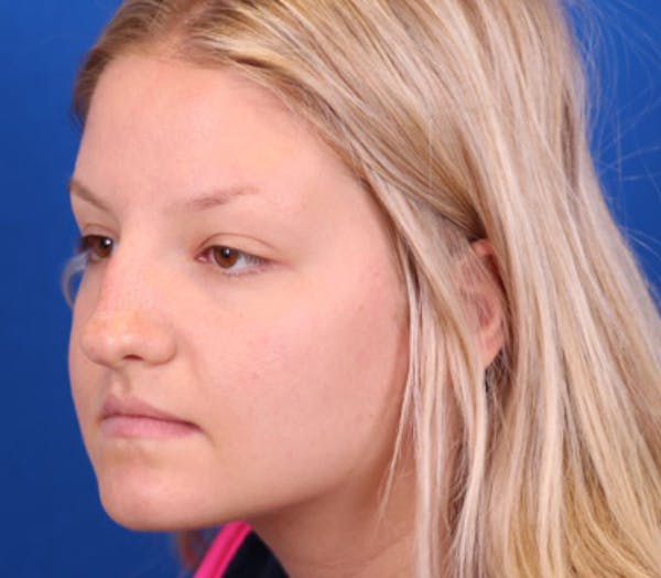 Rhinoplasty Before & After Gallery - Patient 143289171 - Image 3