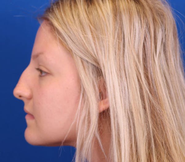 Rhinoplasty Before & After Gallery - Patient 143289171 - Image 1