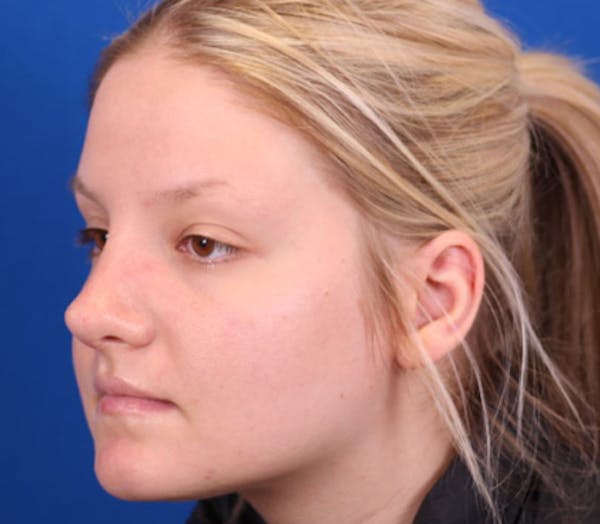 Rhinoplasty Before & After Gallery - Patient 143289171 - Image 4