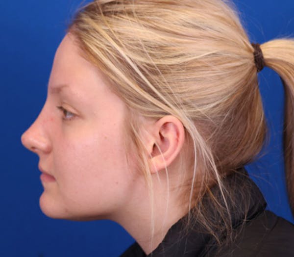 Rhinoplasty Before & After Gallery - Patient 143289171 - Image 2