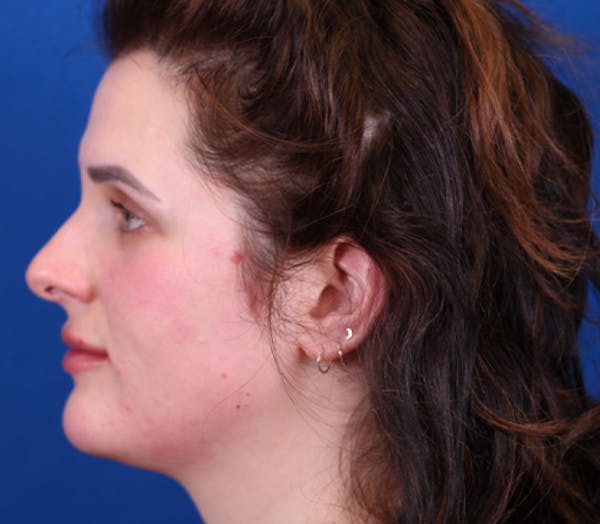Neck Contouring Before & After Gallery - Patient 143289274 - Image 3