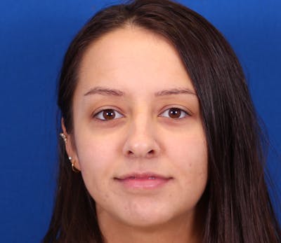 Rhinoplasty Before & After Gallery - Patient 143650300 - Image 1