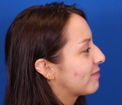 Rhinoplasty Before & After Gallery - Patient 143650300 - Image 1