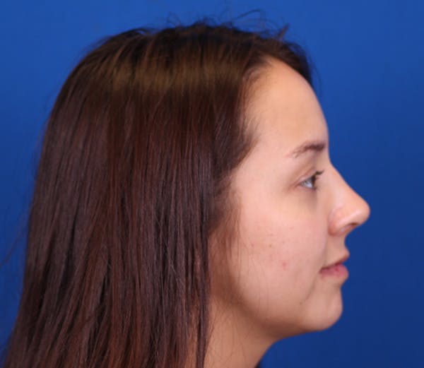 Rhinoplasty Before & After Gallery - Patient 143650300 - Image 2