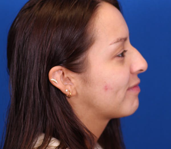 Neck DeFINE Before & After Gallery - Patient 143650363 - Image 5