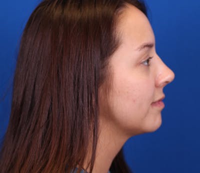 Neck DeFINE Before & After Gallery - Patient 143650363 - Image 6