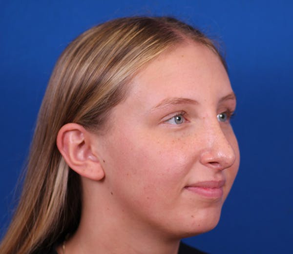 Rhinoplasty Before & After Gallery - Patient 143650446 - Image 4