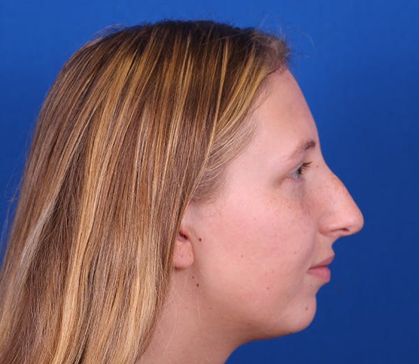 Rhinoplasty Before & After Gallery - Patient 143650446 - Image 3