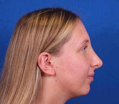 Rhinoplasty Before & After Gallery - Patient 143650446 - Image 6