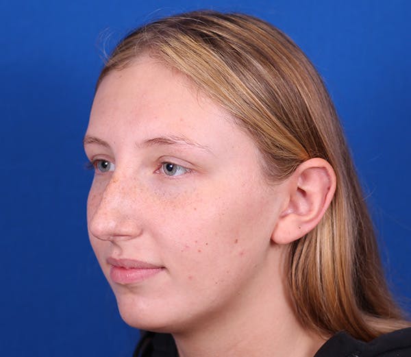 Rhinoplasty Before & After Gallery - Patient 143650446 - Image 7