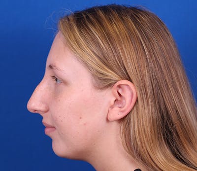 Rhinoplasty Before & After Gallery - Patient 143650446 - Image 1