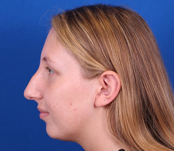 Rhinoplasty Before & After Gallery - Patient 143650446 - Image 9
