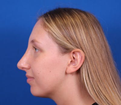 Rhinoplasty Before & After Gallery - Patient 143650446 - Image 10
