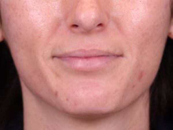 Lip Filler Before & After Gallery - Patient 143650475 - Image 1