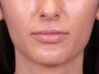 Lip Filler Before & After Gallery - Patient 143650475 - Image 2