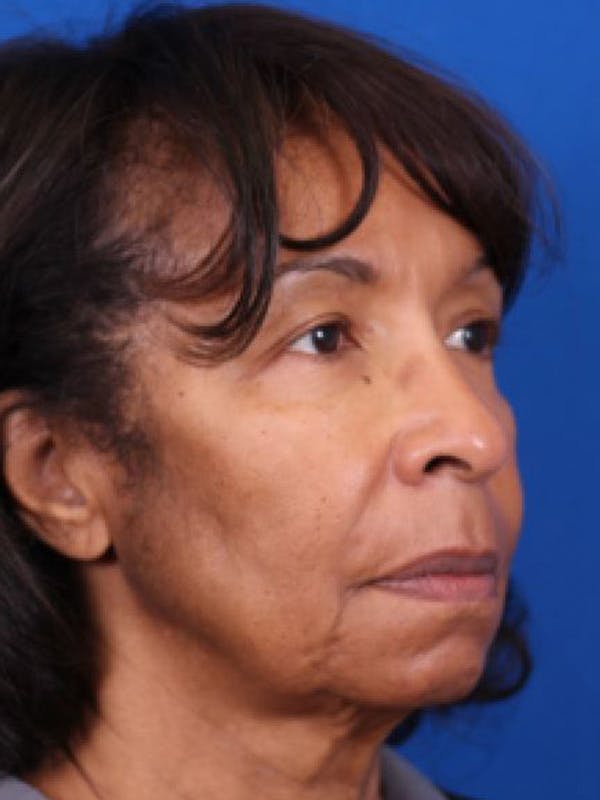 Facelift/Neck Lift Before & After Gallery - Patient 143650820 - Image 3