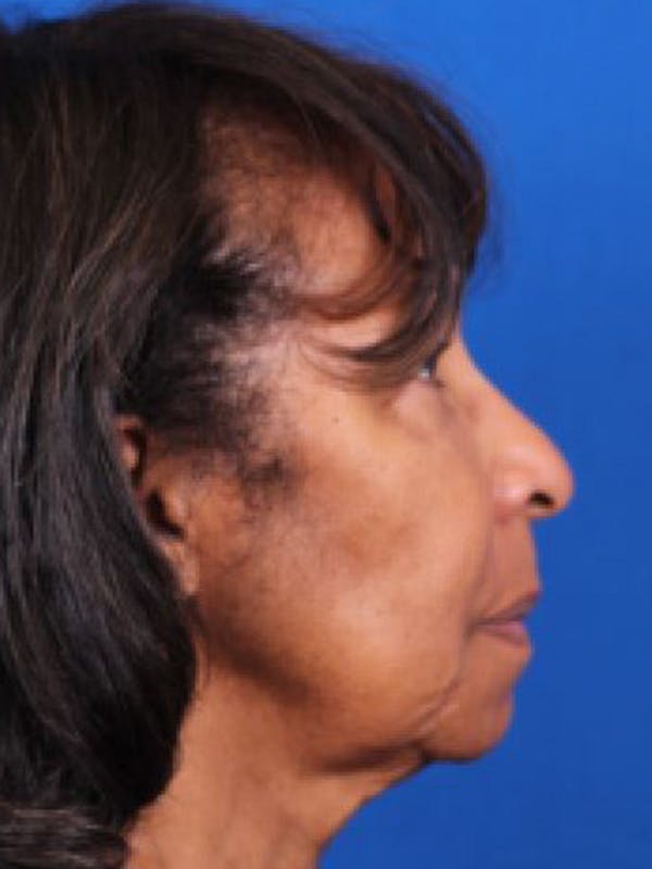 Facelift/Neck Lift Before & After Gallery - Patient 143650820 - Image 5