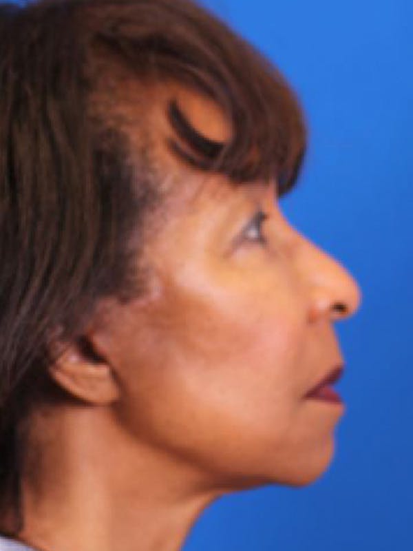 Facelift/Neck Lift Before & After Gallery - Patient 143650820 - Image 6