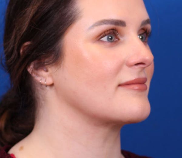 Neck Contouring Before & After Gallery - Patient 143650849 - Image 2