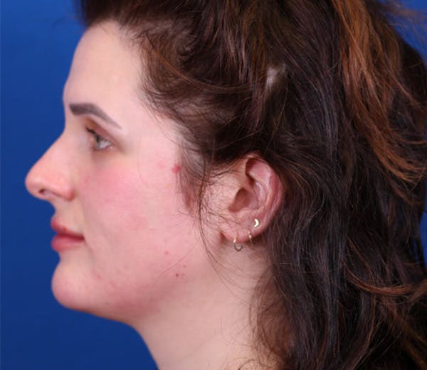 Neck deFINE Before & After Gallery - Patient 143650849 - Image 3